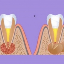 Апікальна хірургія