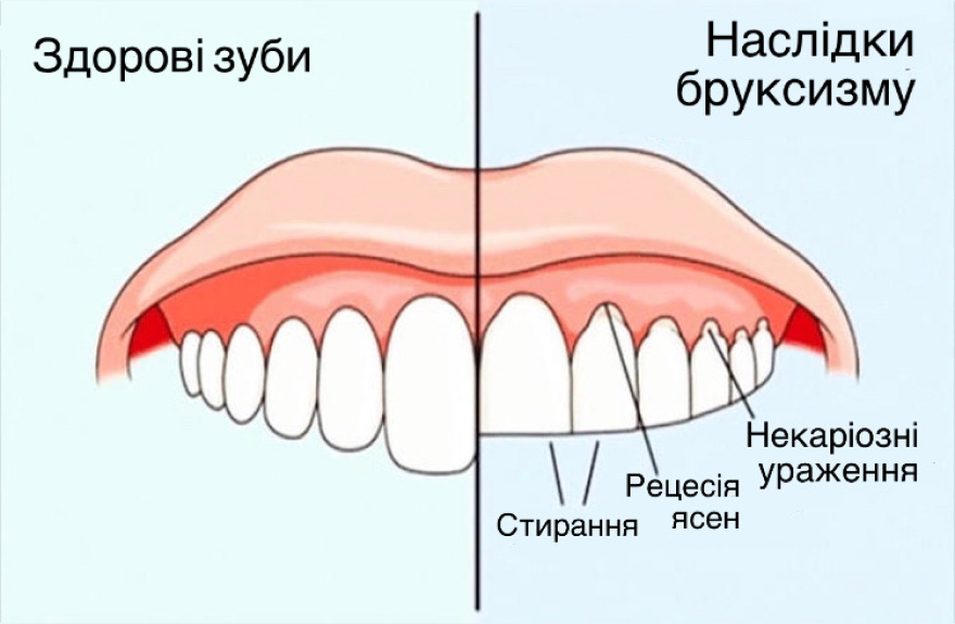 Лікування бруксизму